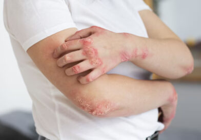 Un tratamiento temprano impacta en la evolución de la psoriasis y previene daños articulares a largo plazo